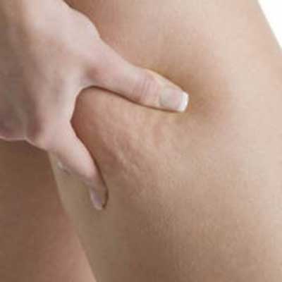acabar com celulite como acabar com a celulite