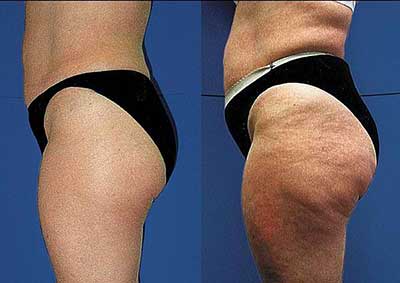 antes e depois2 como acabar com a celulite