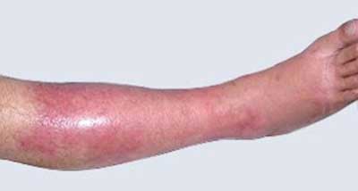 celulite infecciosa1 dicas de tratamento