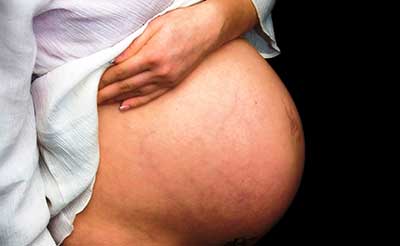 estrias na gestação dicas para gestantes