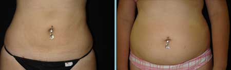 Antes e Depois da Lipoescultura procedimentos estéticos