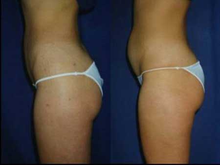 Antes e Depois para mulheres