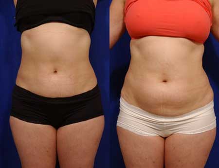 Lipoescultura Antes e Depois da Lipoescultura