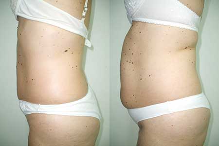 como você fica Antes e Depois da Lipoescultura