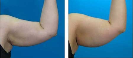 tudo sobre lipoescultura Antes e Depois da Lipoescultura