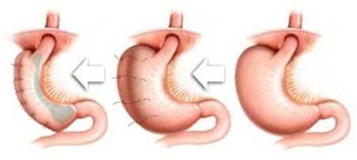o que acontece gastroplastia