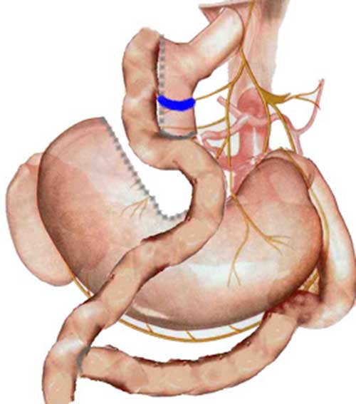 tudo sobre gastroplastia redução de estômago